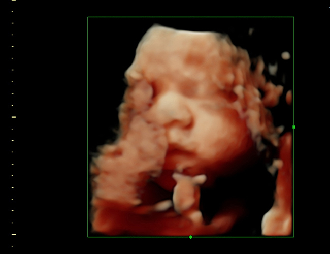 3D ultrasound image at 28 weeks